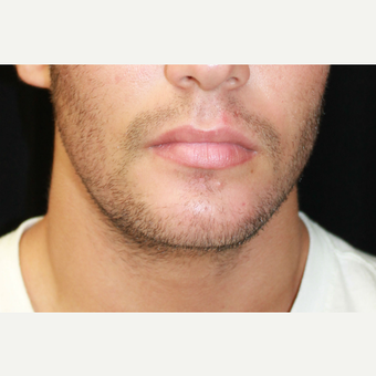 Chin Implant before 3741951 2840271