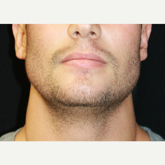 Chin Implant after 3741951 2840272