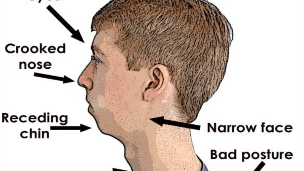 Mouth breathing2222orthotropics2222mike mew2222mewing2222looks theory2222facial growth2222plas