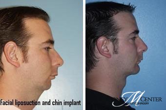 Chin implant2 1