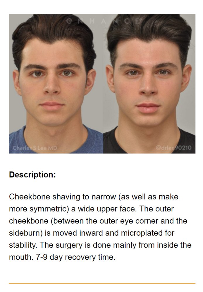 Cheekbone reduction 1