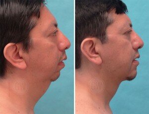chin-implant-03-300x230.jpg