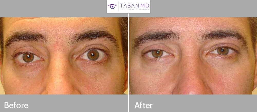 Upper Eyelid Retraction Before After Photos 1