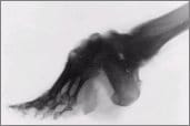 Bound foot X ray