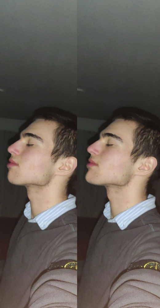 Chinbefore