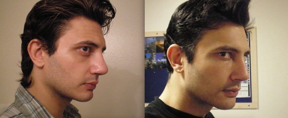 Before after 34