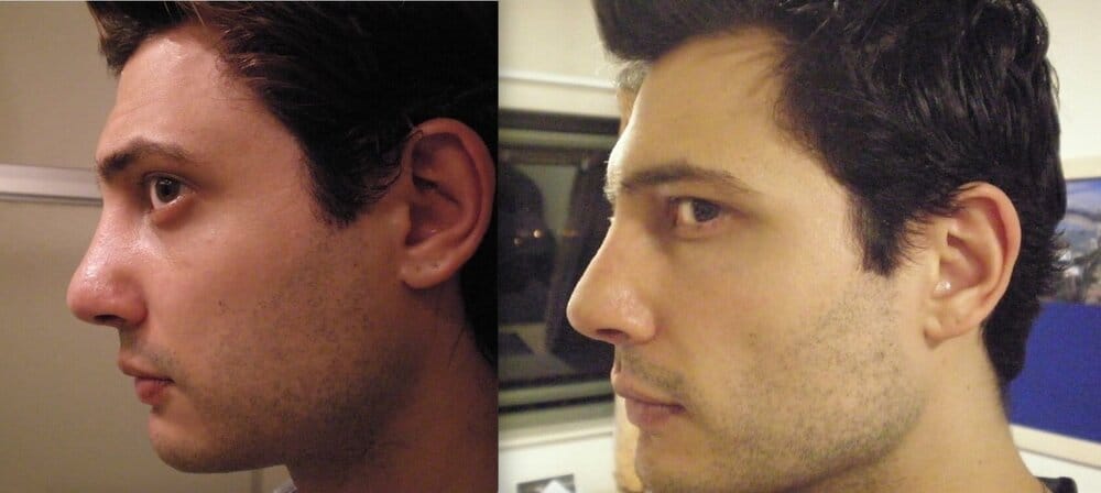 Before after side