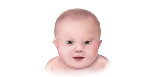 Sm birthdefects down syndrome 600x300