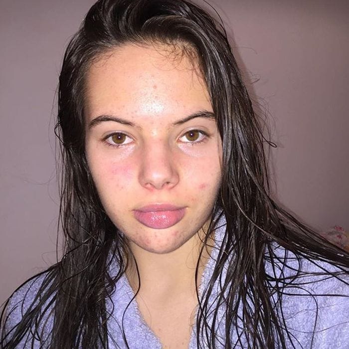 Cdncliqueinccom  cache  posts  251777  acne pimples images 251777 1520625723790 image700x0c