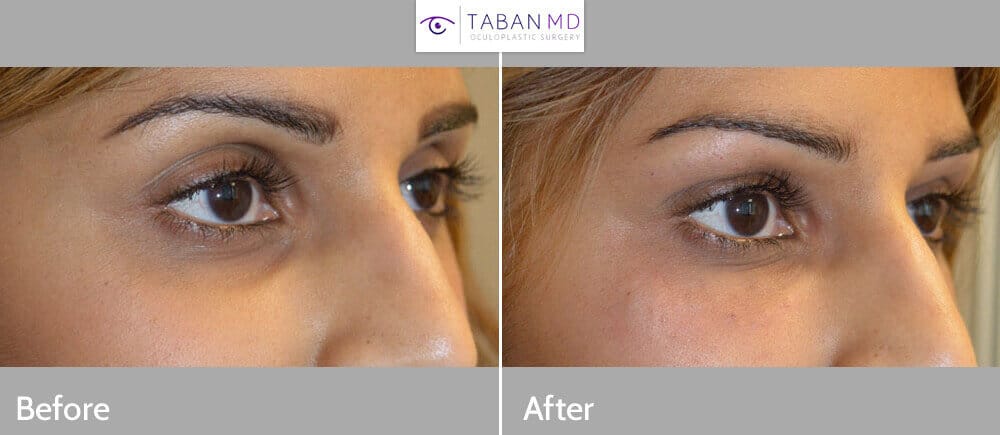 Taban before after 1 1