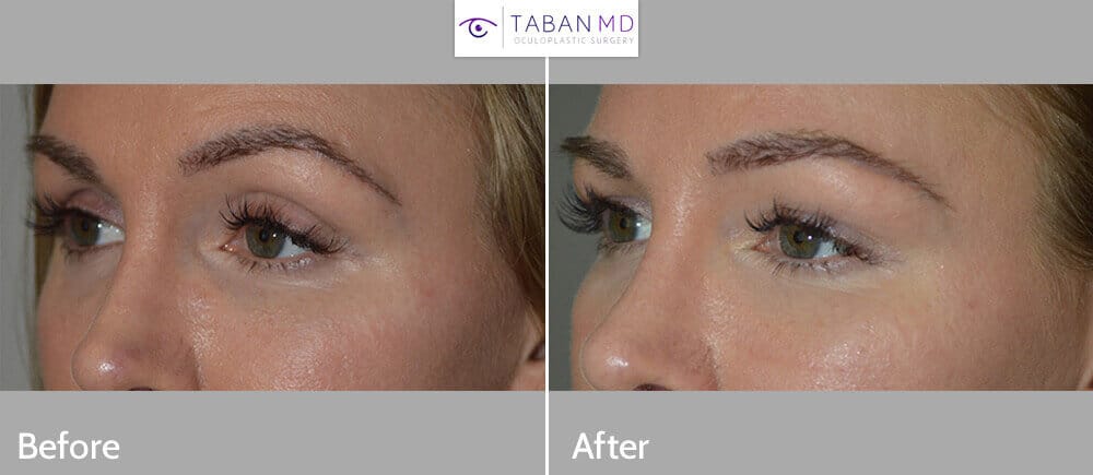 Upper eyelid filler injection LA 1 1