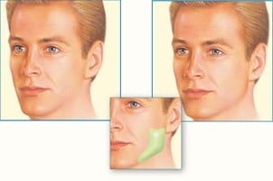 Facial Implants 2 Facial Implants 2