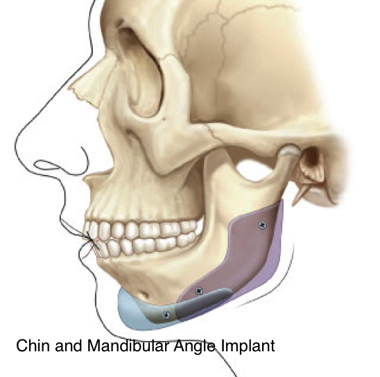 Profile Chin implant Profile Chin implant