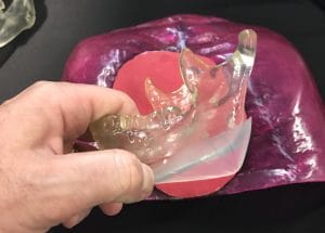 Jaw angle implant 300x215 Jaw angle implant 300x215