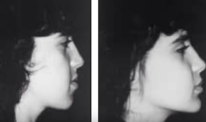Example of Good Jaw Surgery Result