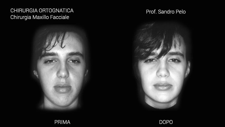 2slider chirurgia ortognatica