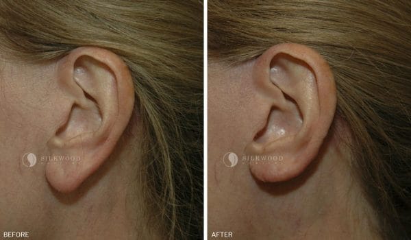 Earlobe reduction surgery dr warwick nettle 1 1 600x350