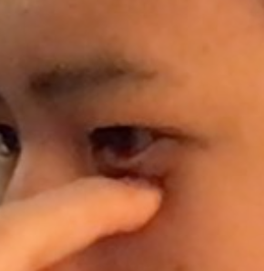 Infraorbital Rim Elevation