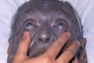 Argyria