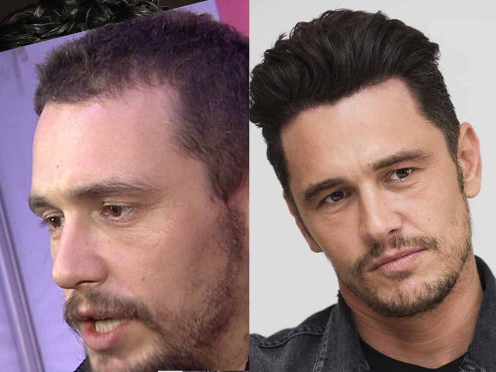 James franco hair transplant before and after