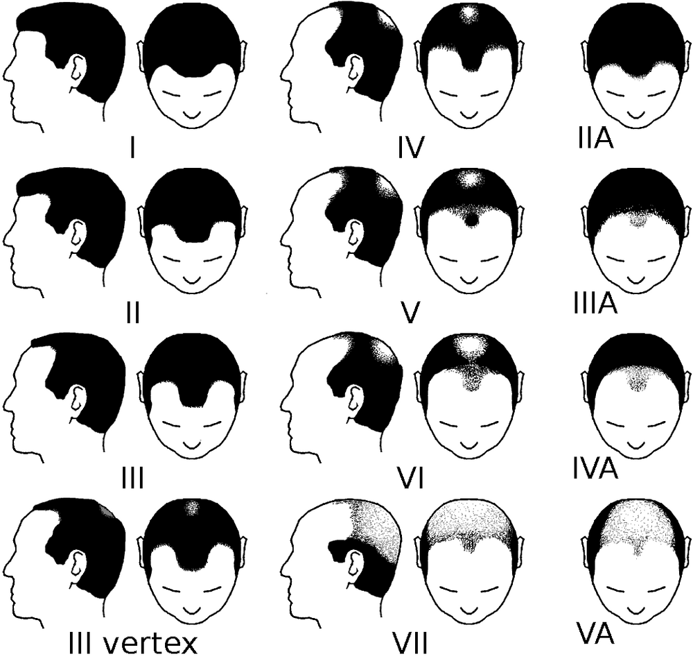 Partial Norwood scale for male pattern baldness