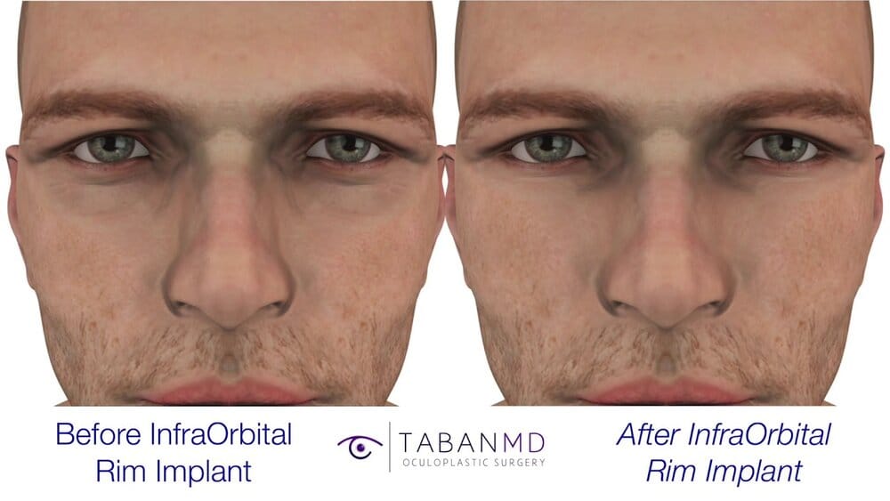 Infraorbital implant what it does