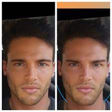 Rate Amnesia after some more surgeries | Looksmax.me - Men's  Self-Improvement & Aesthetics