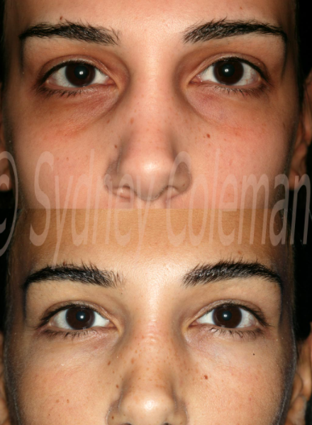 Darkeyelid