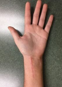 Palm-incision-213x300.jpg