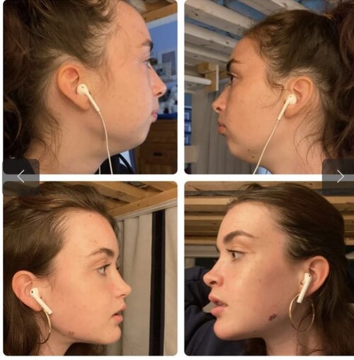Example of Good Jaw Surgery Result