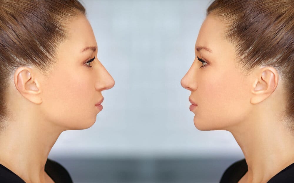 Img genioplasty before after
