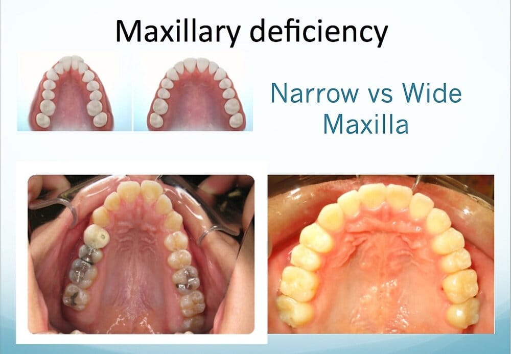 Narrowvswidepalate