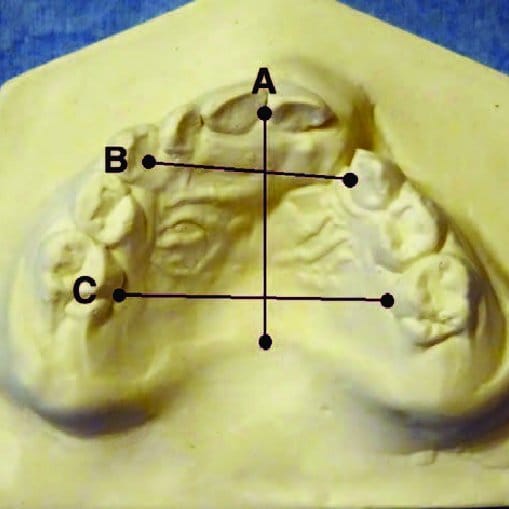 Maxillari mesure