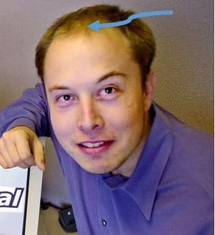 Elon Musk Bald