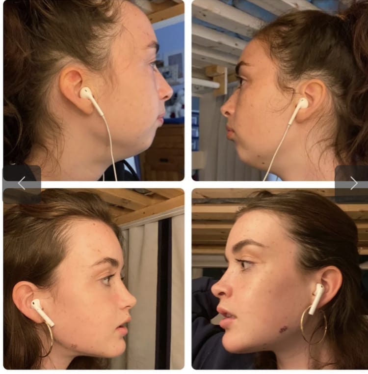 Example of Good Jaw Surgery Result Example of Good Jaw Surgery Result