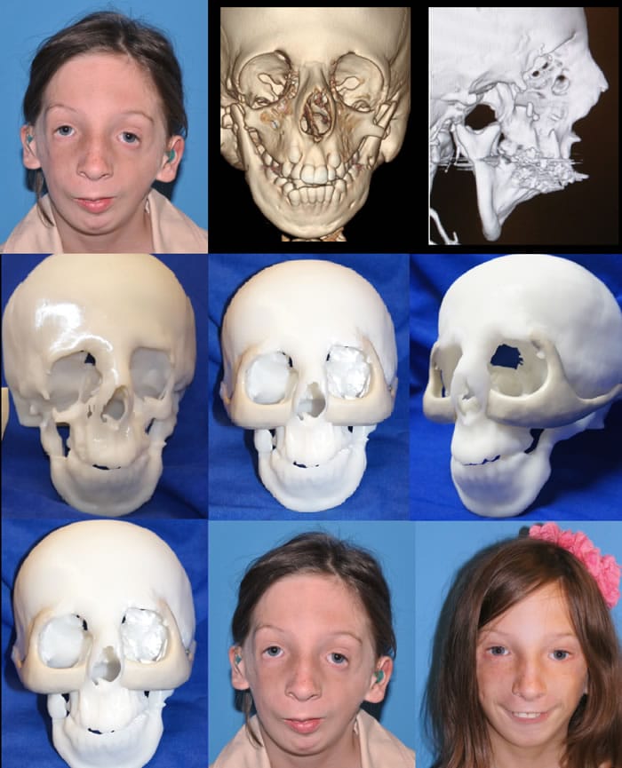 Treacher Collins Syndrome 1