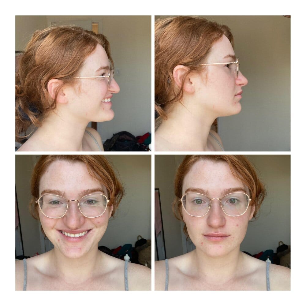 Nose flare 4
