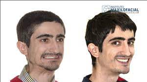 MANUEL: Oligodontia, bone atrophy, short face syndrome - Bone  reconstruction, dental implants - YouTube