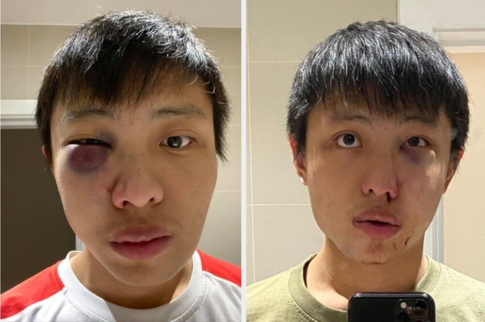 An asian student said he was beaten up by men who 2 585 1583343227 6 dblbig