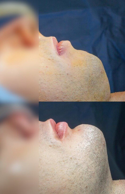 Lord madness chin difference before and after