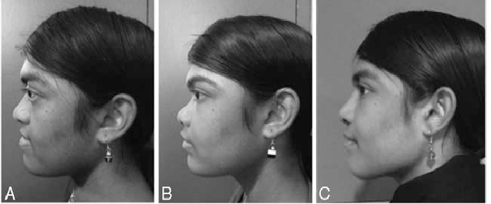 Composite picture of patient 1 of Cruzon syndrome who underwent a modified LeFort 3