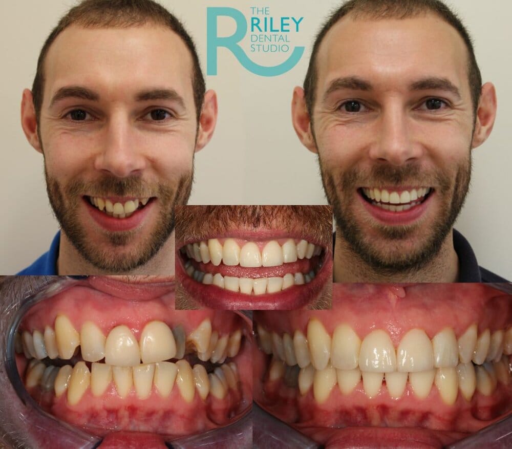 Nick Bradbury Before After Invisalign 1024x898