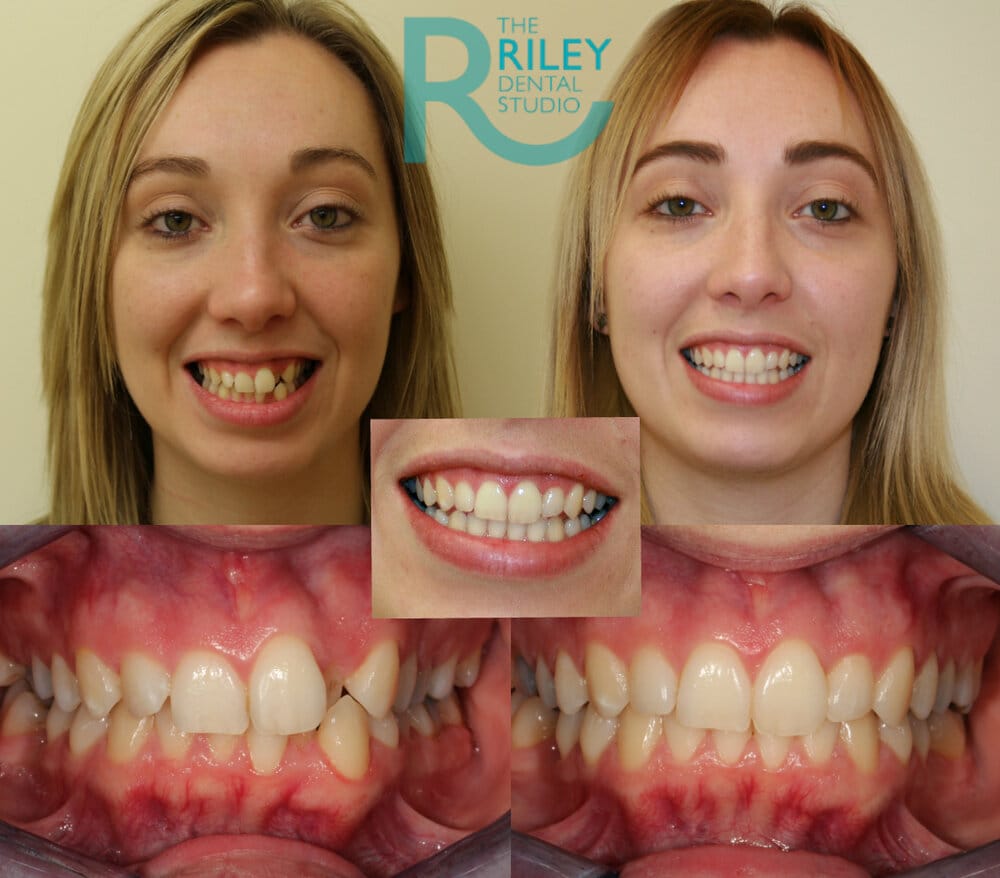 Becky Before After 1