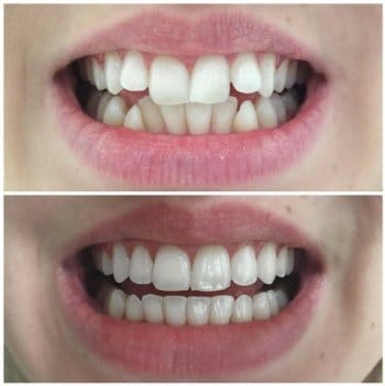 Invisalign results1