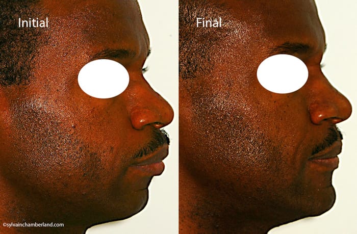 Afroamericain protrusion bimaxillaire RoPhi Chamberland Orthodontiste a Quebec