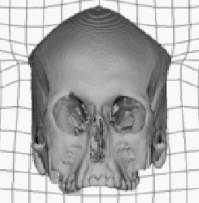 Temporalis affect on orbitals