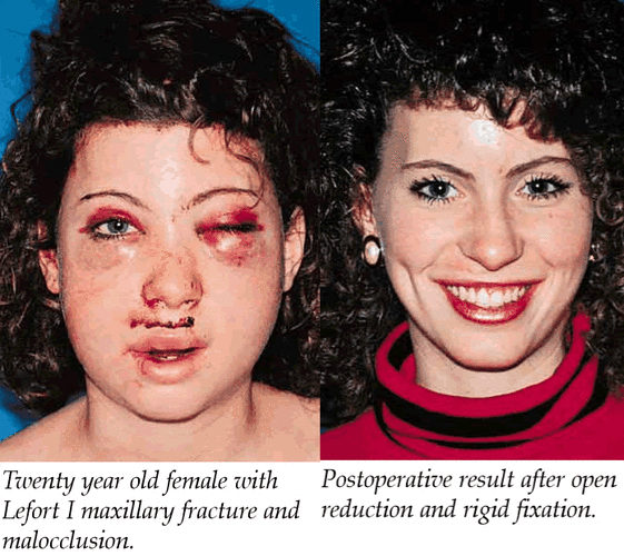 Good Jaw Surgery Result Lefort I  Zygo Ostetomy