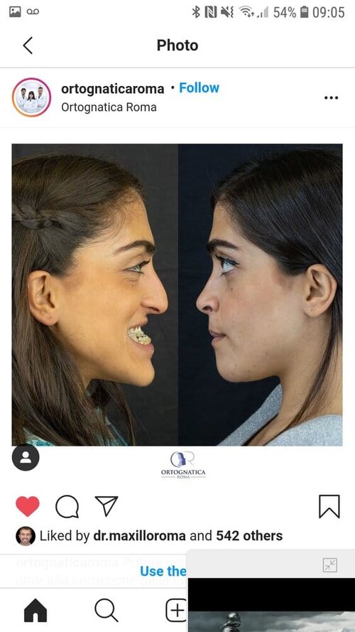 Example of Good Jaw Surgery Result