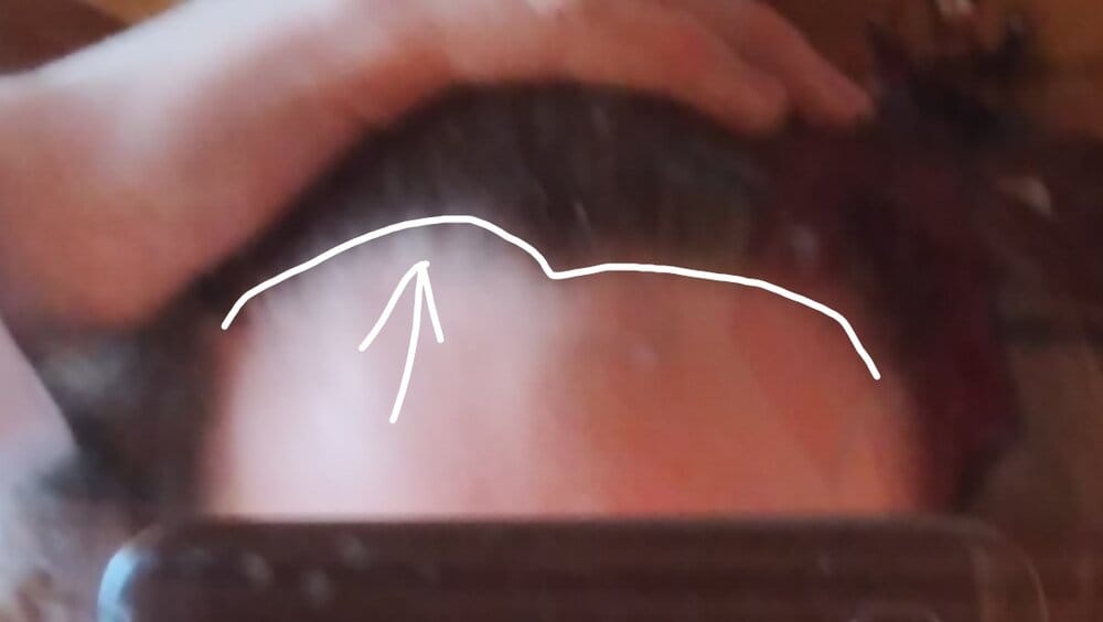 Balding2