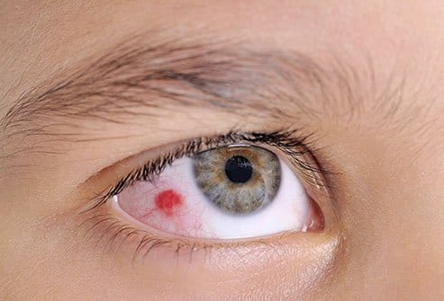 Subconjunctival hemorrhage 1